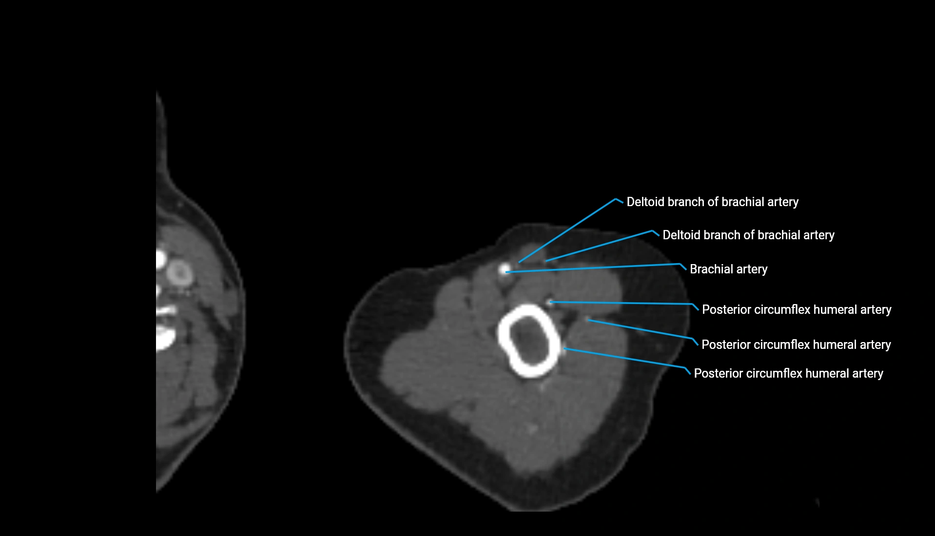 CTA upper limb axial cross sectional anatomy labelled image 306 (2).webp